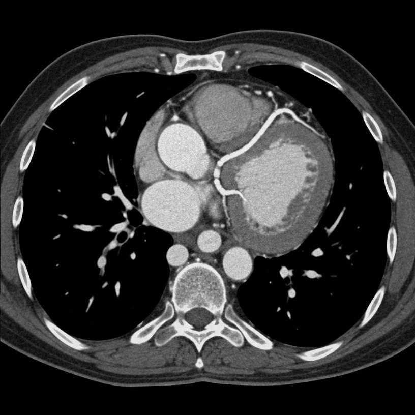 CT angiography